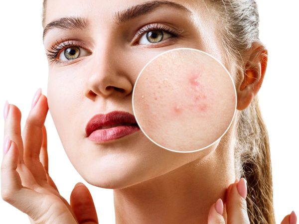 Young,Woman,With,Acne,Skin,In,Zoom,Circle.,Isolated,On